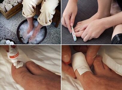 Fumando os pés e aplicando crema de urea ás uñas afectadas por fungos