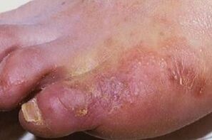 manifestacións dunha infección fúngica na pel das pernas