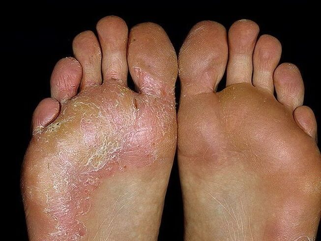 síntomas dunha fungo no pé