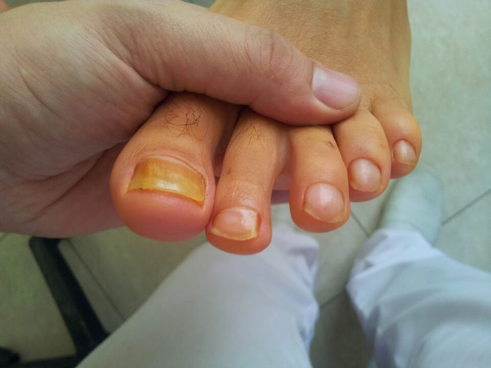 amareleamento das uñas dos pés con fungo