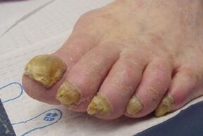 síntomas de fungo das unhas dos pés