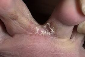 fungo na pel entre os dedos dos pés