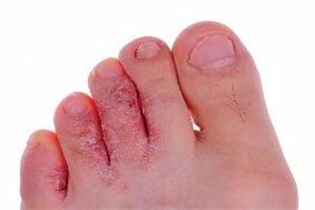síntomas de fungo do dedo do pé