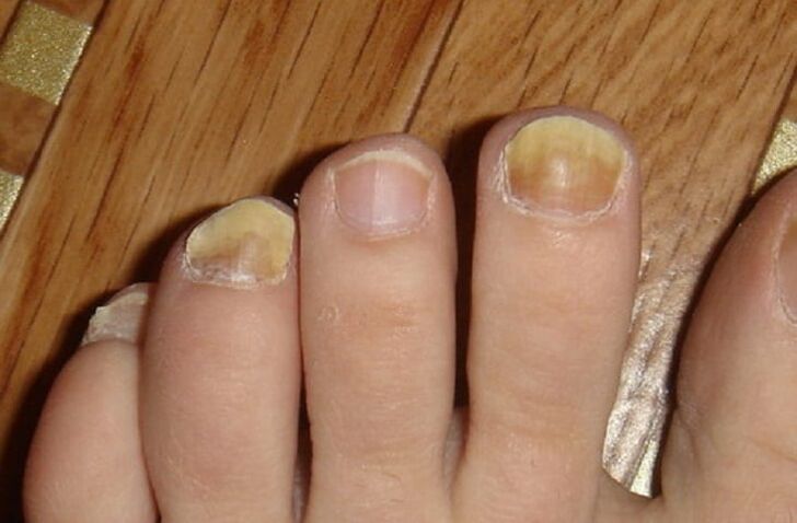 síntomas de fungo nas uñas e na pel dos pés