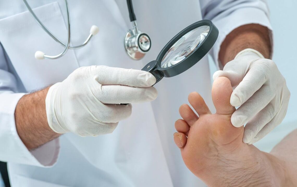 médico examina os pés con fungo