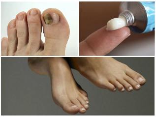 lume das uñas dos pés tratamento